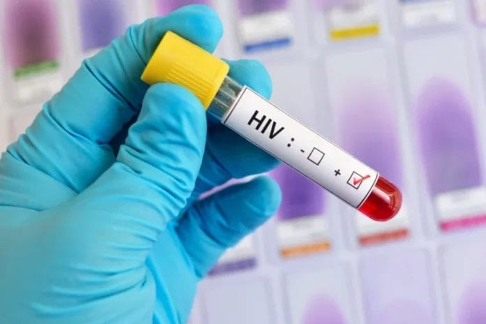 Paciente de VIH logró eliminar todo rastros del virus sin tratamiento