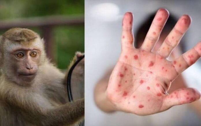 nuevos casos de la viruela del mono en Yucatán