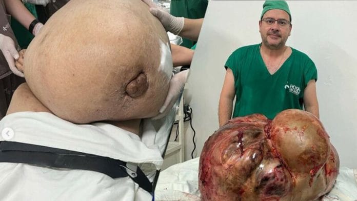 Médicos extirpan tumor de 46 kg a una mujer (FOTO)