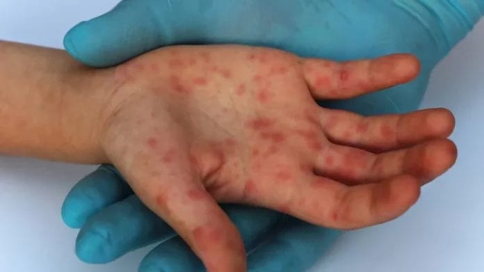 Al alza los casos de varicela en Yucatán