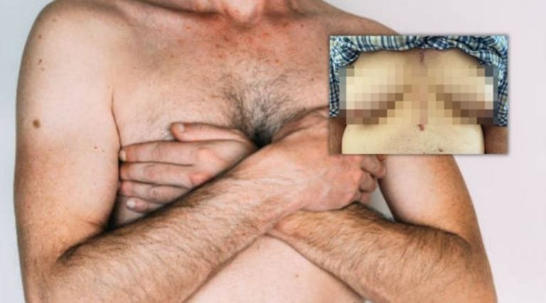 Medicamento le jugó chueco: abuelito desarrolla tremendos pechos tras tratamiento
