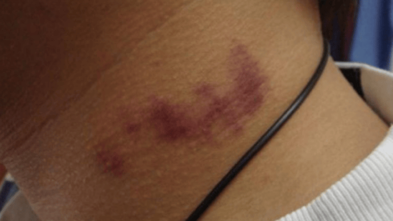 Chavito queda “frío” tras recibir un chupetón en el cuello